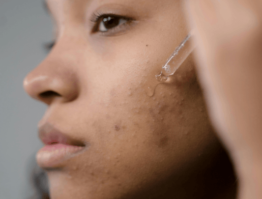 Pregnancy-Friendly Options for Acne Prone Skin